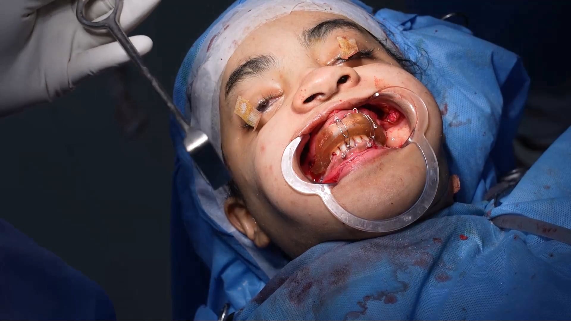 Jaw Surgery for a Girl with Face problems